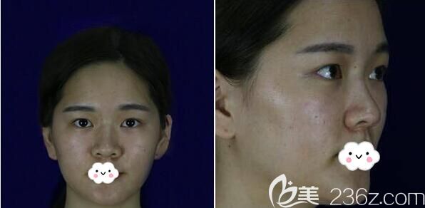 四川友谊医院整形美容科雷蕾术前照片1