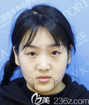 找安徽维多利亚卫爱侠做面部吸脂瘦脸术前设计方案 找安徽维多利亚卫爱侠做面部吸脂瘦脸术前设计方案