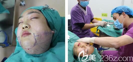 卫爱侠面部吸脂手术过程中 卫爱侠面部吸脂手术过程中