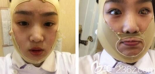 安徽维多利亚整形面部吸脂后第3天照片 安徽维多利亚整形面部吸脂后第3天照片