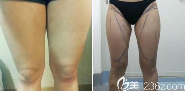 四川友谊医院马懿术前照片1