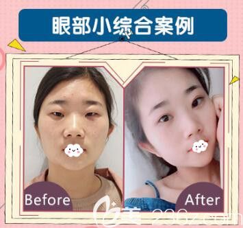 荆州华美李杰双眼皮+开眼角+提肌+去脂去皮案例