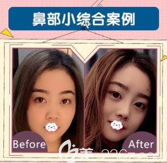 荆州华美李杰鼻综合案例效果对比图