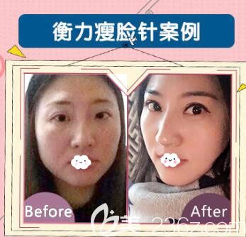荆州华美注射瘦脸除皱瘦脸案例