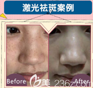 荆州华美激光祛斑真人案例效果对比图