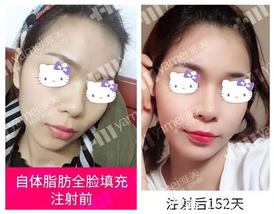 廖伟龙主任做自体脂肪面部填充152天后效果