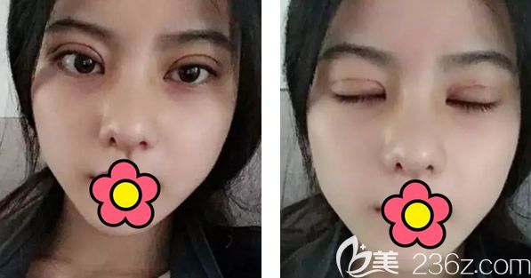 切开双眼皮+半肋软骨隆鼻第三天