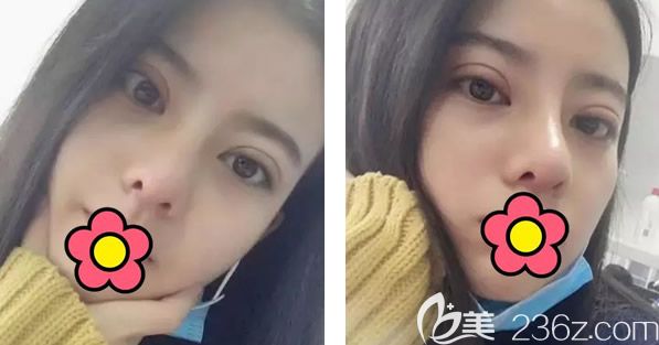 呼市五洲割双眼皮隆鼻第七天拆线