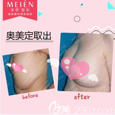 广州美恩许扬滨奥美定取出+假体隆胸案例 广州美恩许扬滨奥美定取出+假体隆胸案例
