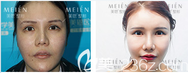 广州美恩许扬滨隆鼻失败修复案例 广州美恩许扬滨隆鼻失败修复案例