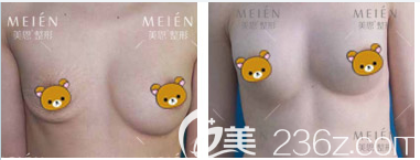 广州美恩许扬滨做的奥美定取出真人案例 广州美恩许扬滨做的奥美定取出真人案例