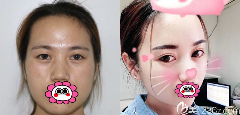 李继鹏双眼皮案例 李继鹏双眼皮案例