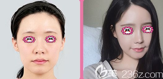 隆鼻对比图 隆鼻对比图