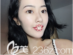 刘彦龙做双眼皮怎么样 刘彦龙做双眼皮怎么样