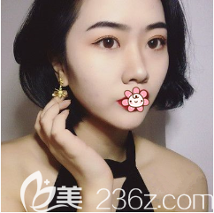 重庆艺星整形双眼皮加自体脂肪面部填充术后2个月 重庆艺星整形双眼皮加自体脂肪面部填充术后2个月