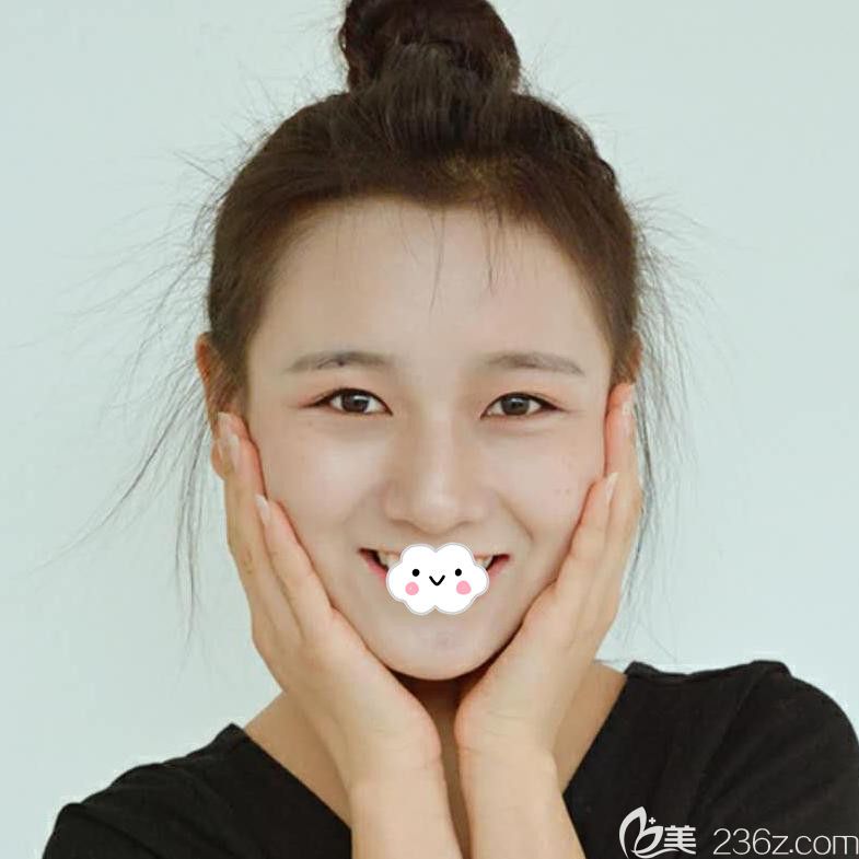 武汉壹加壹付俊俐眼部修复真人案例 武汉壹加壹付俊俐眼部修复真人案例