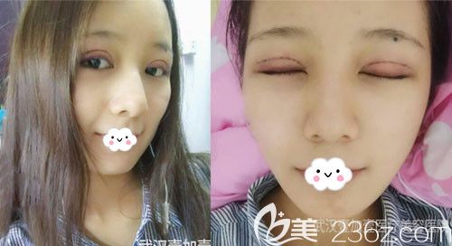 武汉壹加壹付俊俐双眼皮修复术后疤痕效果 武汉壹加壹付俊俐双眼皮修复术后疤痕效果