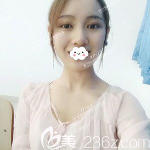 武汉壹加壹付俊俐双眼皮修复术后效果 武汉壹加壹付俊俐双眼皮修复术后效果