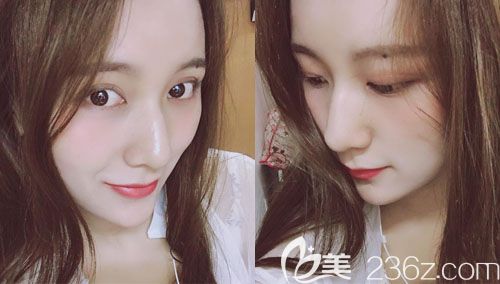 武汉壹加壹付俊俐双眼皮失败修复案例术后恢复图片 武汉壹加壹付俊俐双眼皮失败修复案例术后恢复图片