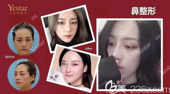 重庆艺星整形隆鼻好不好 重庆艺星整形隆鼻好不好