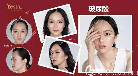 重庆艺星整形玻尿酸隆鼻怎么样 重庆艺星整形玻尿酸隆鼻怎么样