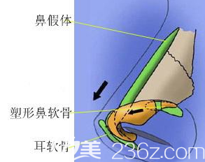 除去自体吸收的部分鼻综合总体来说可以达到一个的效果