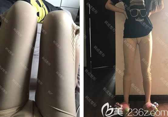 我在南宁韩成整形做大腿360环吸第3天