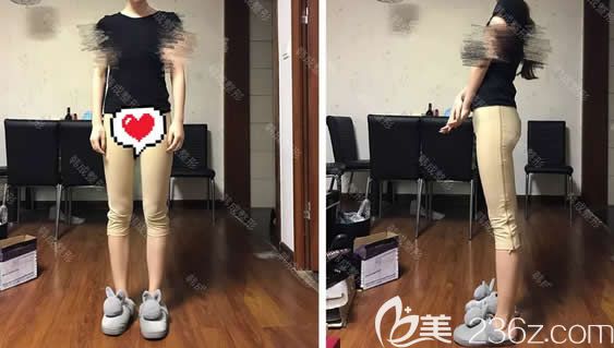 我在南宁韩成整形做大腿环形吸脂第10天