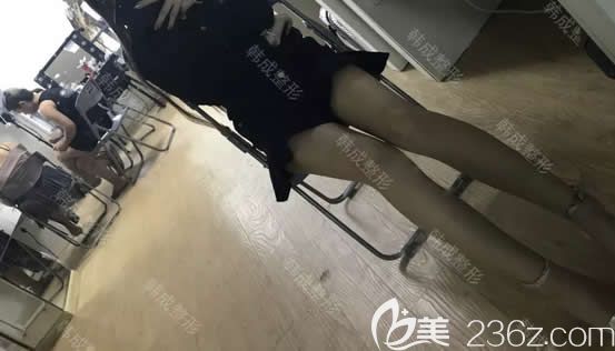我在南宁韩成整形做腿部吸脂第30天