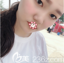 术前我的塌鼻 术前我的塌鼻