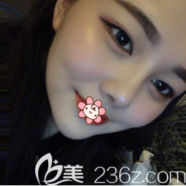 刘彦龙鼻综合术后一个月 刘彦龙鼻综合术后一个月