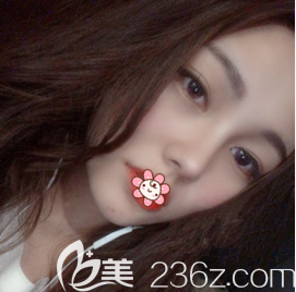 重庆艺星整形鼻综合术后40天 重庆艺星整形鼻综合术后40天