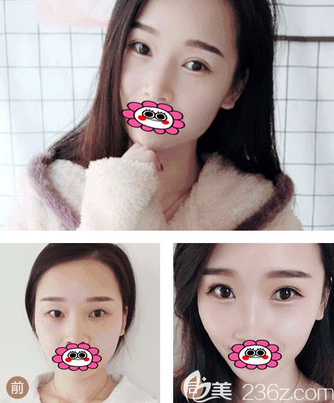 西安画美整形医院双眼皮效果图 西安画美整形医院双眼皮效果图