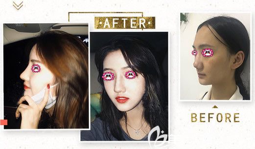 画美整形医院隆鼻变化图 画美整形医院隆鼻变化图