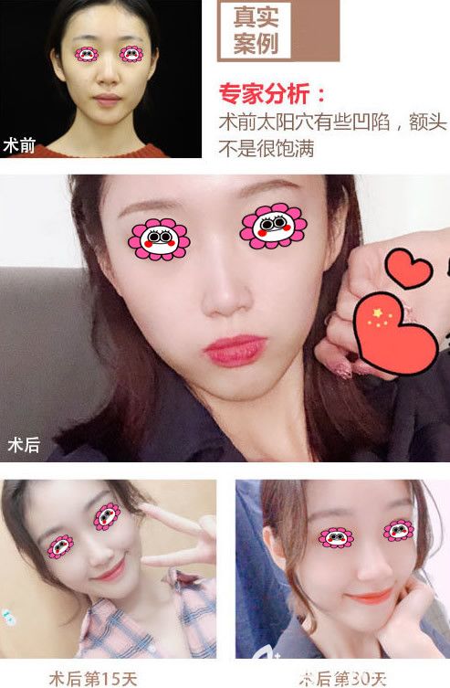 西安画美面部脂肪填充对比图 西安画美面部脂肪填充对比图