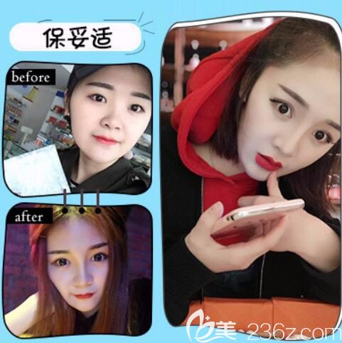 合肥韩美整形注射瘦脸除皱瘦脸瘦脸案例 合肥韩美整形注射瘦脸除皱瘦脸瘦脸案例