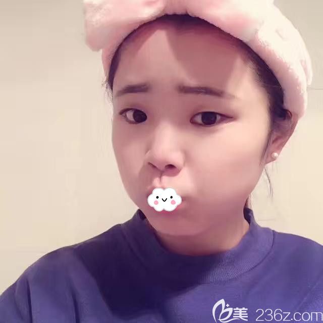 荆州华美<!--<i data=20240703-sp></i>-->双眼皮+开眼角+假体隆鼻真人案例 荆州华美<!--<i data=20240703-sp></i>-->双眼皮+开眼角+假体隆鼻真人案例