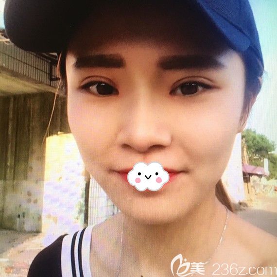 荆州华美<!--<i data=20240703-sp></i>-->眼综合+假体隆鼻案例术后效果 荆州华美<!--<i data=20240703-sp></i>-->眼综合+假体隆鼻案例术后效果