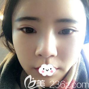 荆州华美割双眼皮效果怎么样?<!--<i data=20240703-sp></i>-->眼综合案例 荆州华美割双眼皮效果怎么样?<!--<i data=20240703-sp></i>-->眼综合案例