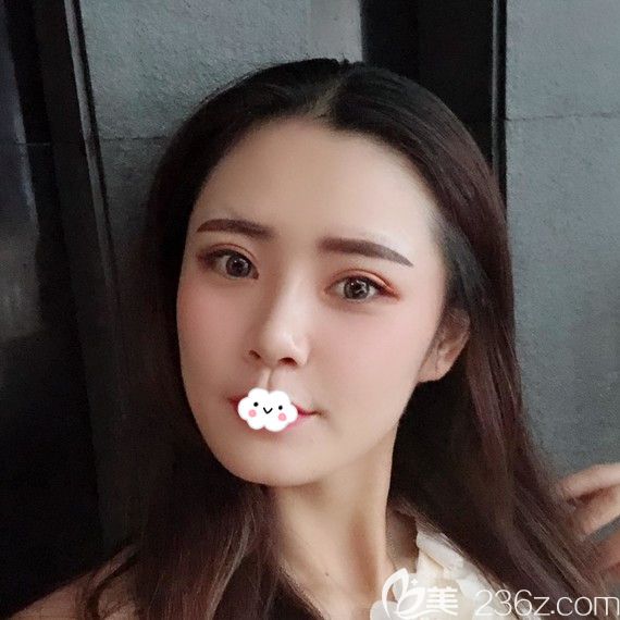 荆州华美<!--<i data=20240703-sp></i>-->双眼皮案例术后恢复效果图 荆州华美<!--<i data=20240703-sp></i>-->双眼皮案例术后恢复效果图