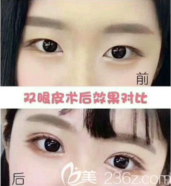 念奴娇整形医院做双眼皮案例 念奴娇整形医院做双眼皮案例