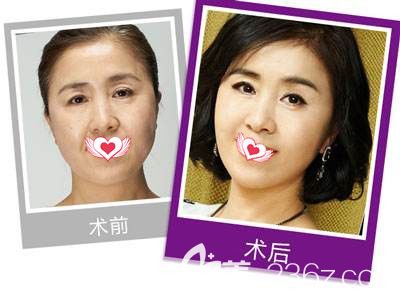 秦皇岛念奴娇做除皱案例 秦皇岛念奴娇做除皱案例