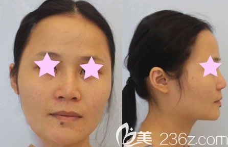 我在南宁梦想整形做面部填充前的照片 我在南宁梦想整形做面部填充前的照片