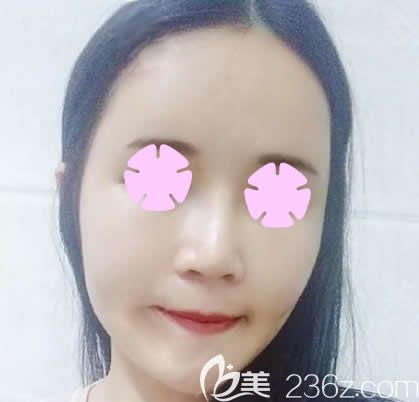 我在南宁梦想做全脸自体脂肪填充后第3天 我在南宁梦想做全脸自体脂肪填充后第3天