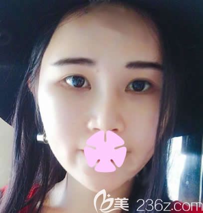 这是我在南宁梦想整形做全脸自体脂肪填充亲身经历及术前术后对比图，可以美美哒过年啦