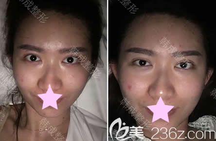 我在南宁韩成做面部线雕除皱当天