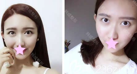 在南宁韩成做全脸线雕提升第7天