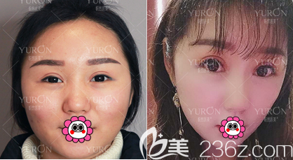 北京悦然面部吸脂案例术前与术后25天对比效果