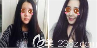 医院整形美容科吕敏鼻综合真人案例