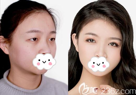 张主任做切开双眼皮术后105天恢复效果